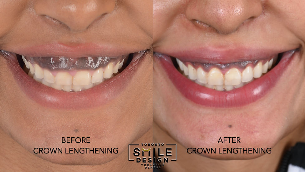 How to fix Gummy Smile Crown Lengthening Toronto